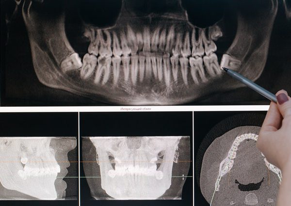 Invisalign – co to jest? Oto nowoczesny aparat ortodontyczny.